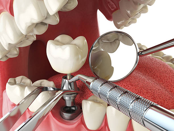 Best Emergency Tooth Extraction in Merrifield, VA